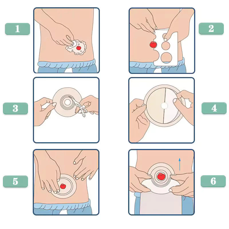 Bolsa de Colostomia Descartável 1 Peça com Barreira Hidrocoloide – Kit 10 Unidades Viva Secura