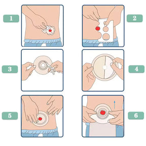 Bolsa de Colostomia Descartável 1 Peça com Barreira Hidrocoloide – Kit 10 Unidades Viva Secura